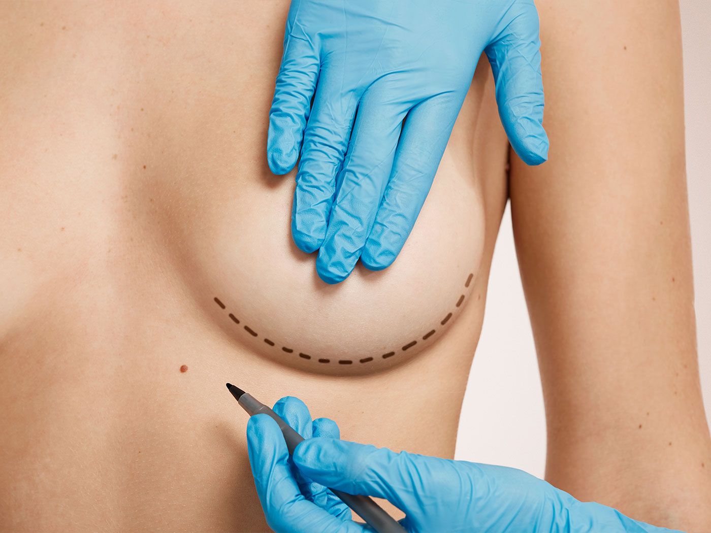 Plastic surgery Royal | Breast surgery. What are the prices?