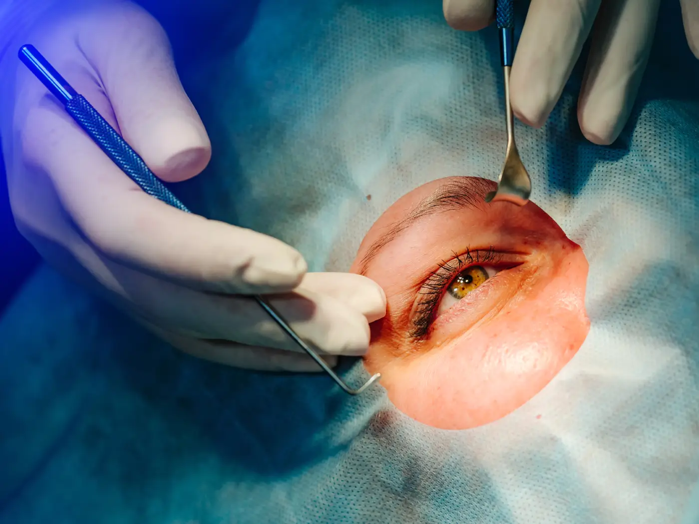 Plastic surgery Royal | Experiences with Eyelid Surgery