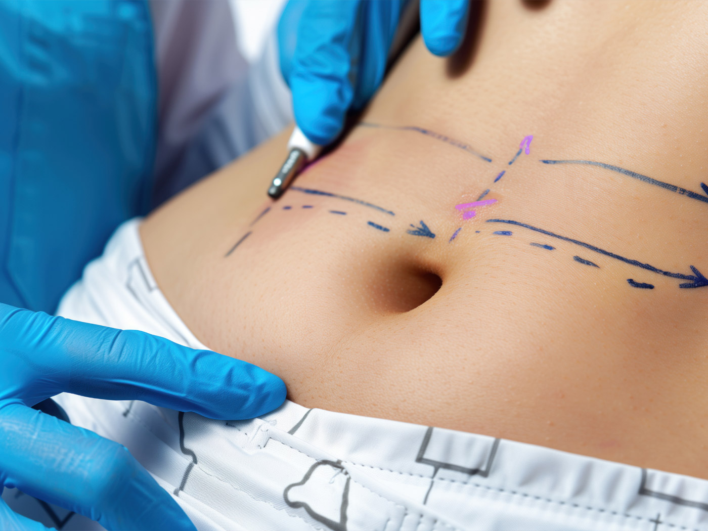 Plastic surgery Royal | The biggest misconceptions about liposuction