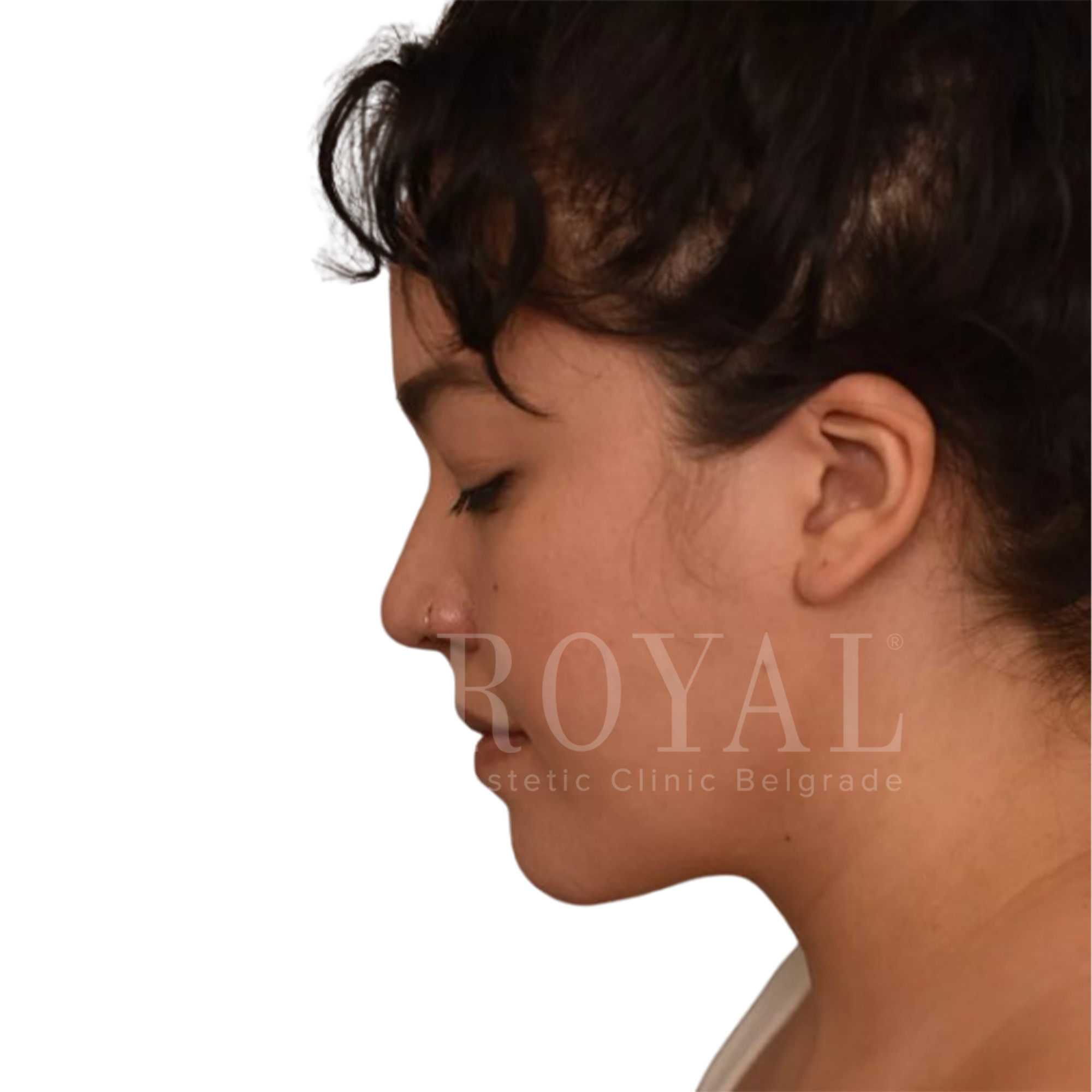 Estetska kirurgija Royal | Pred in po
