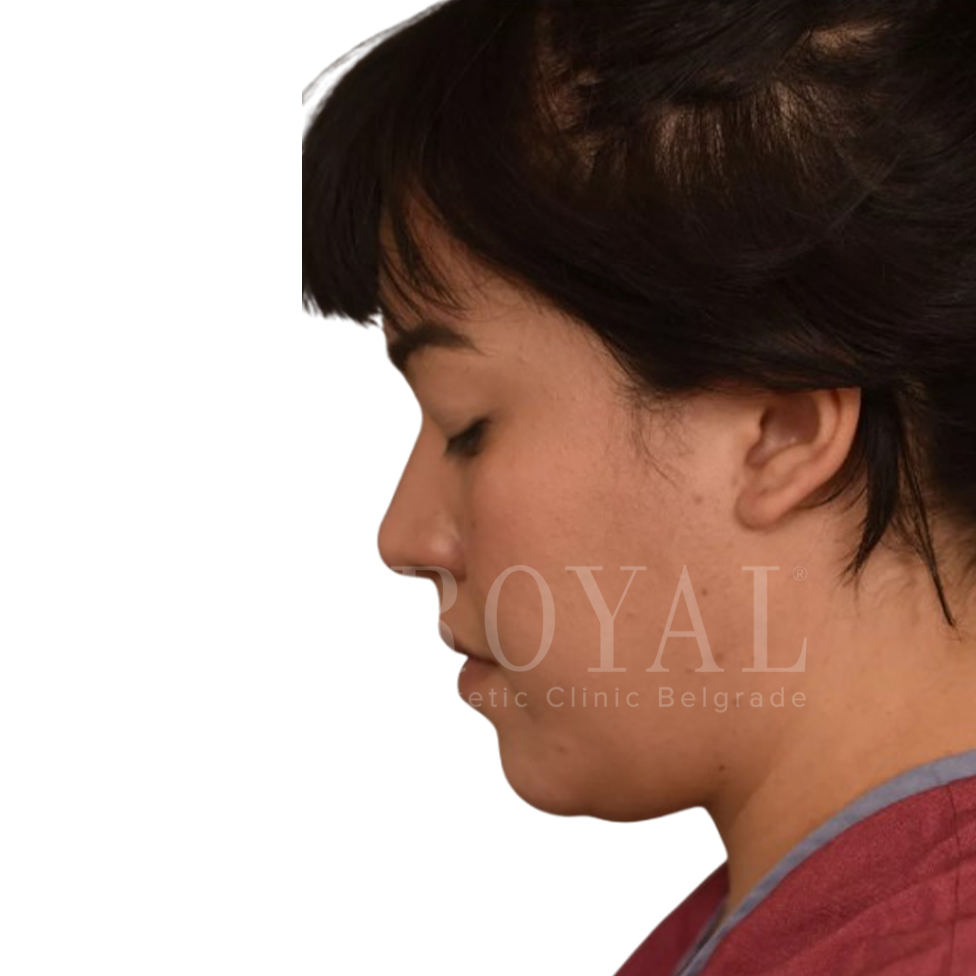 Estetska kirurgija Royal | Pred in po