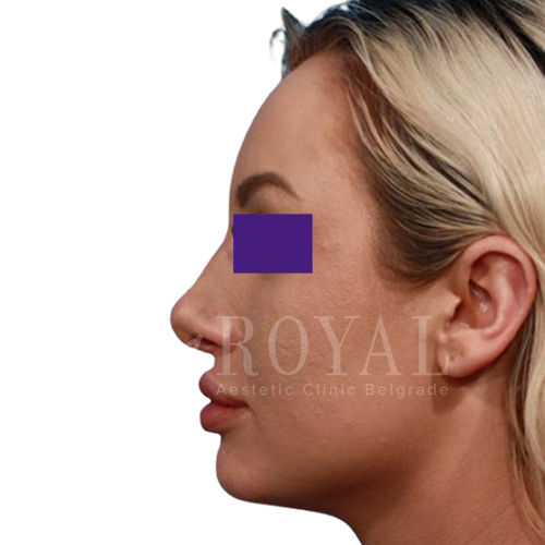 Estetska kirurgija Royal | Pred in po