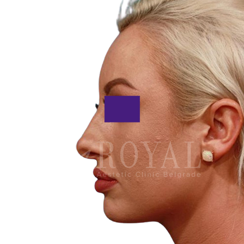 Estetska kirurgija Royal | Pred in po