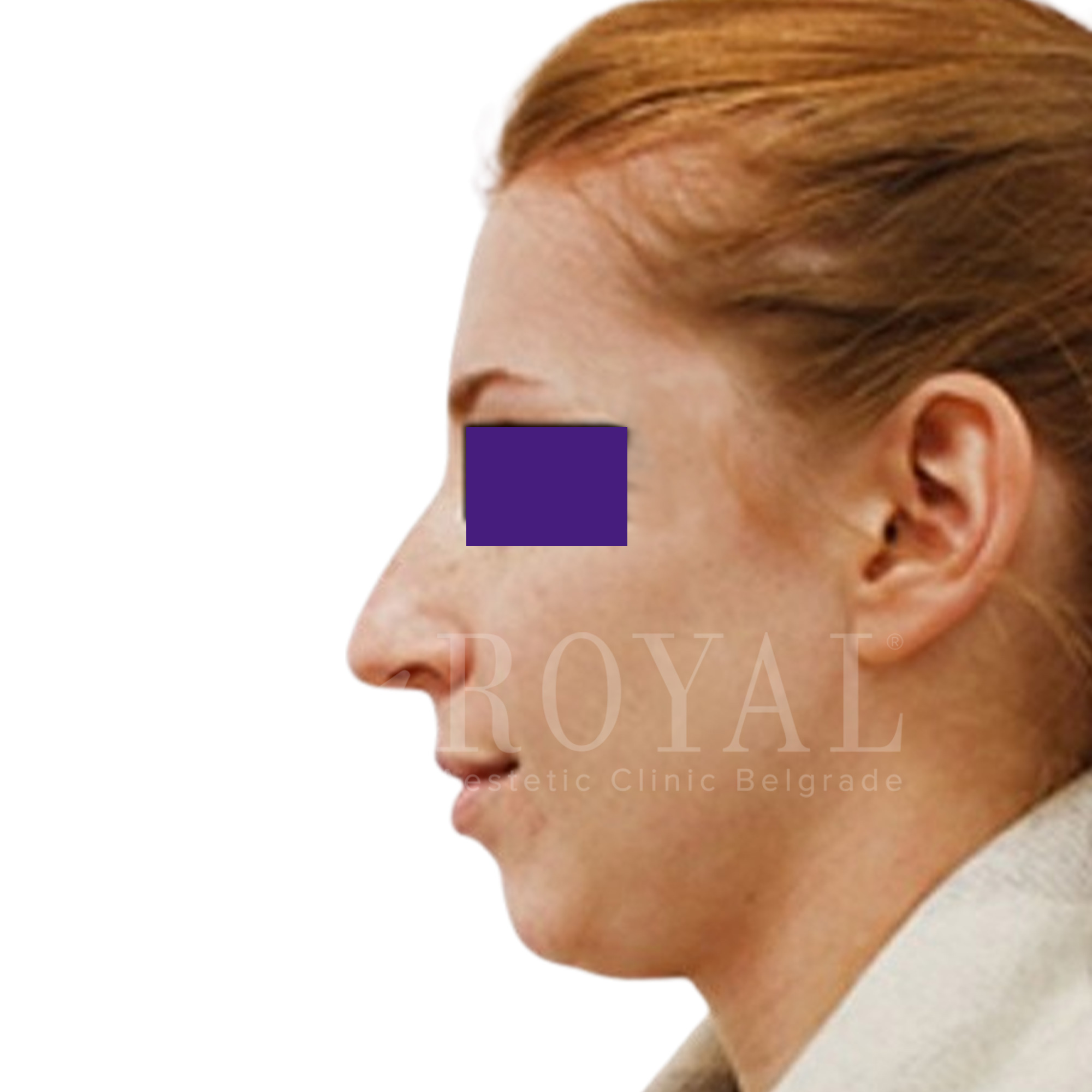 Estetska kirurgija Royal | Pred in po