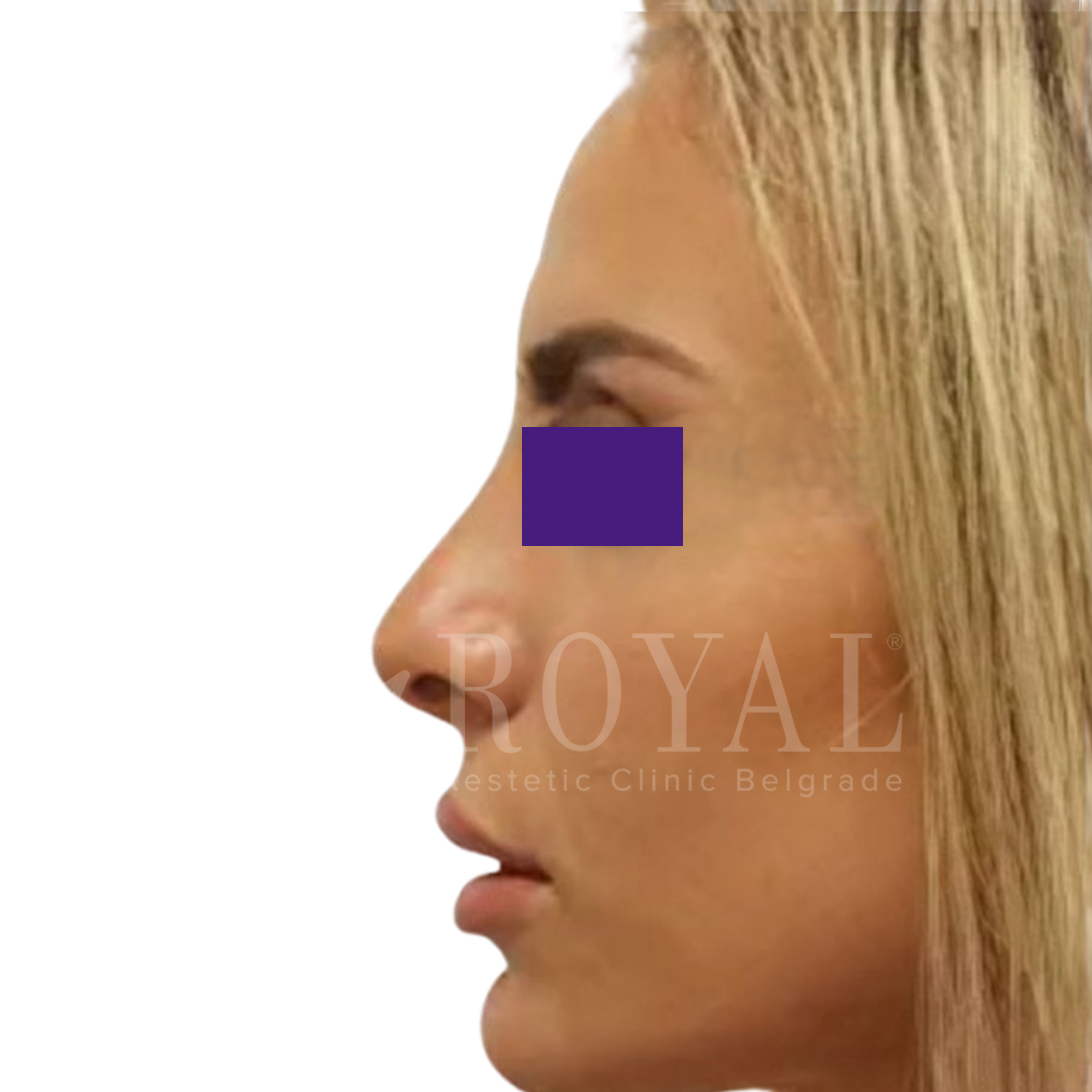 Estetska kirurgija Royal | Pred in po
