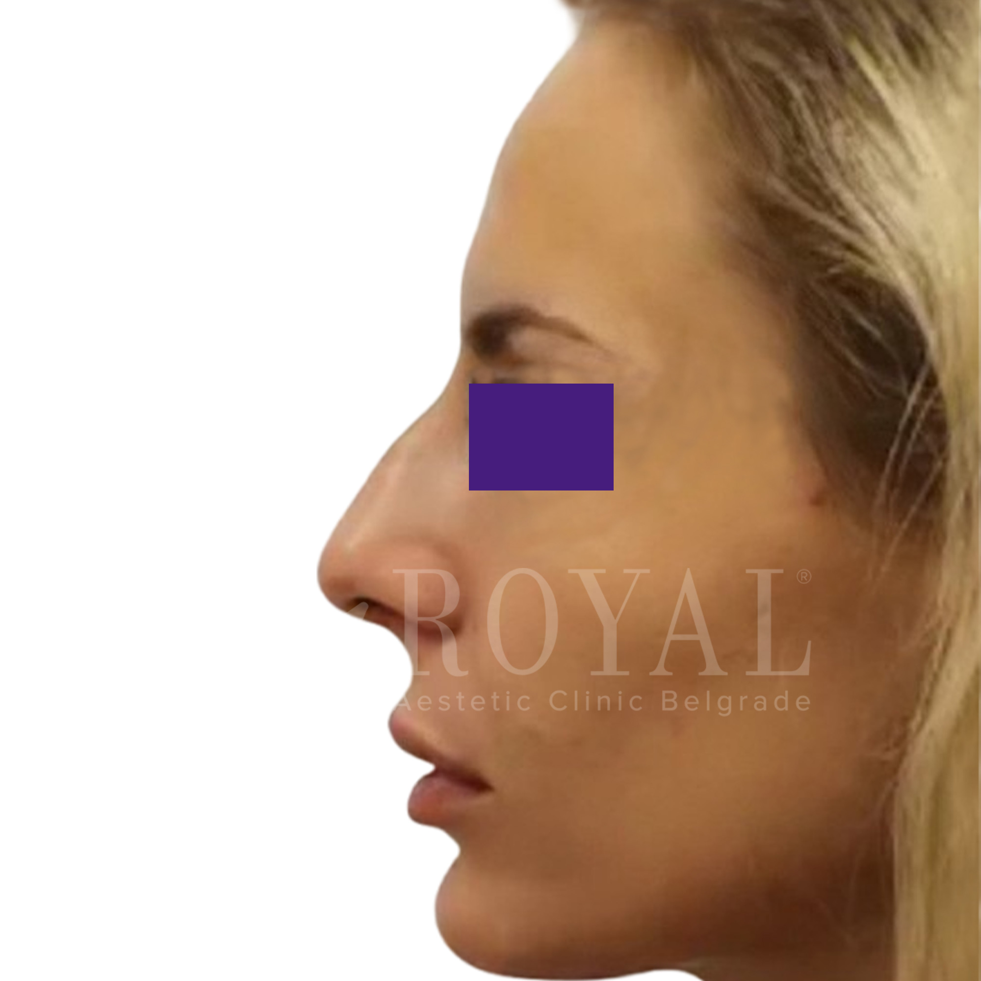 Estetska kirurgija Royal | Pred in po