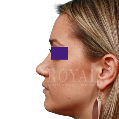 Estetska kirurgija Royal | Pred in po