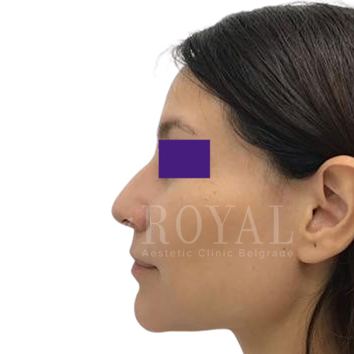 Estetska kirurgija Royal | Pred in po