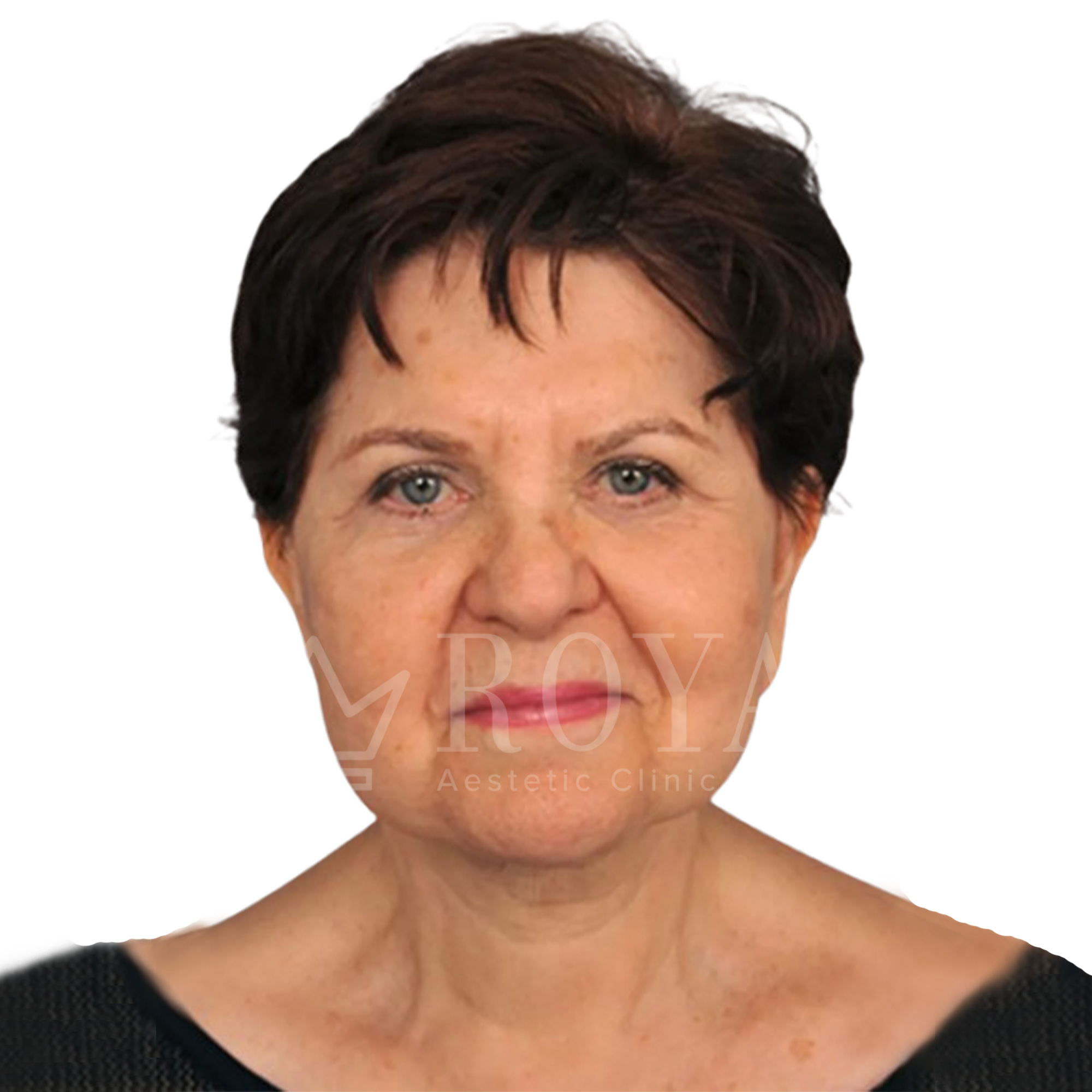 Estetska kirurgija Royal | Pred in po