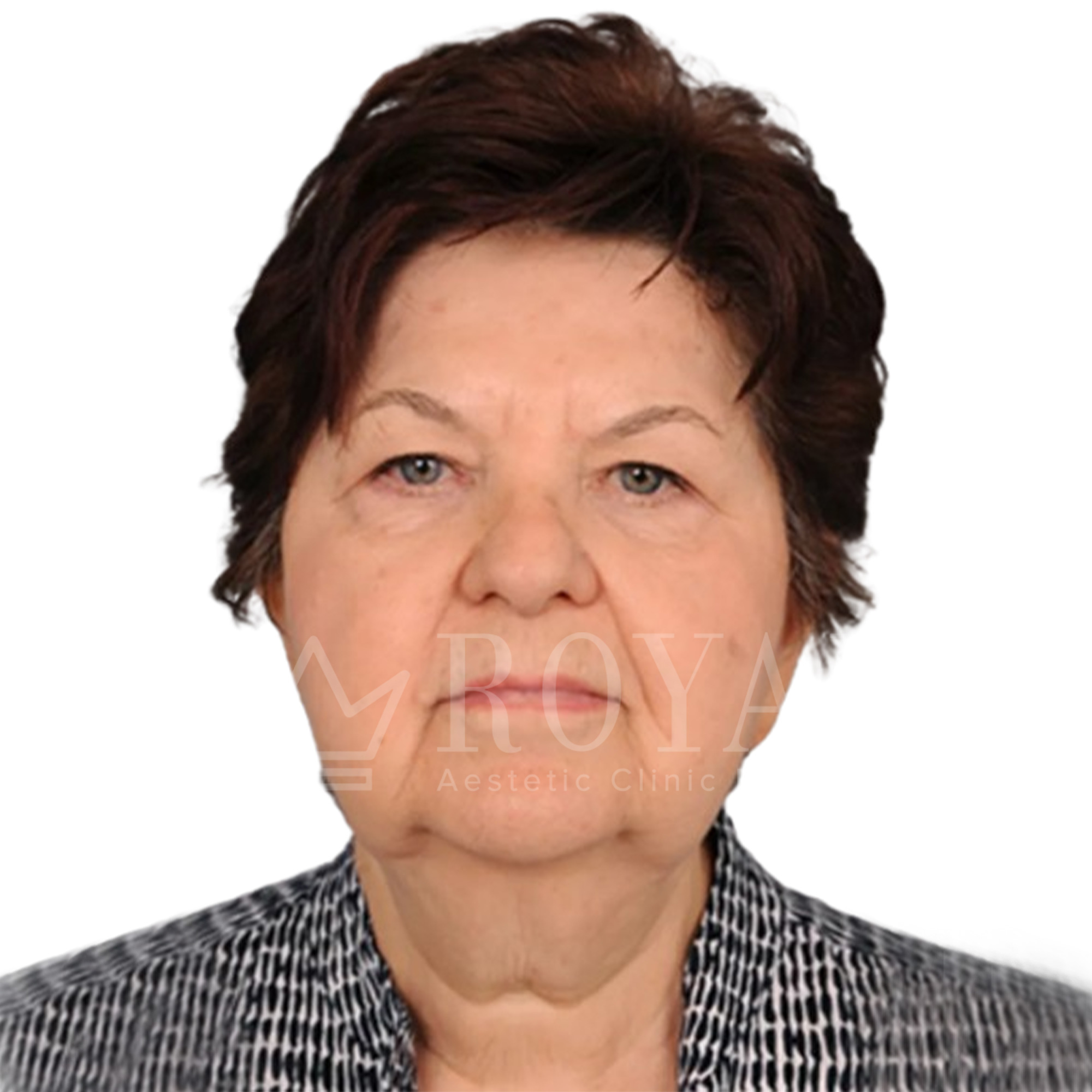 Estetska kirurgija Royal | Pred in po