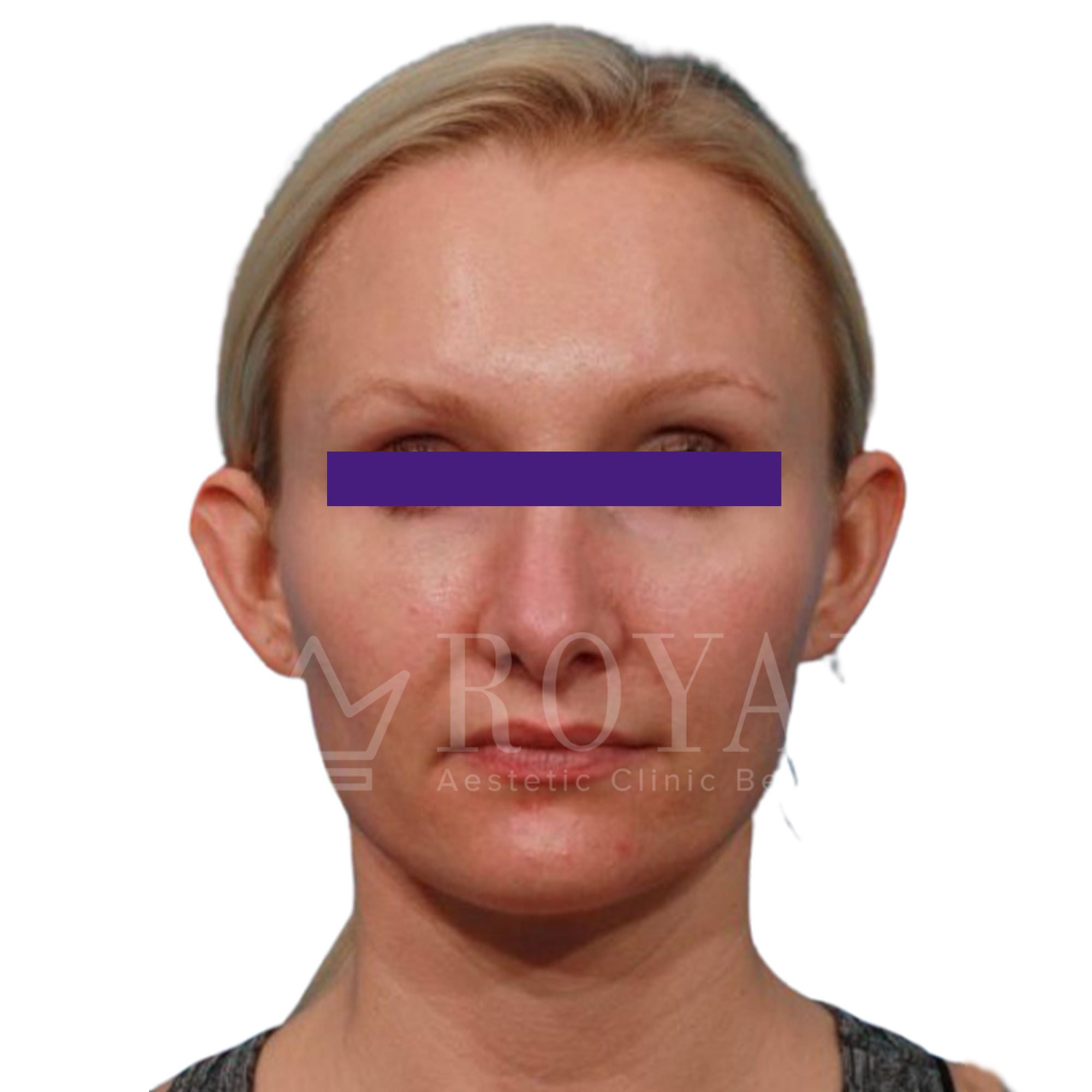 Estetska kirurgija Royal | Pred in po