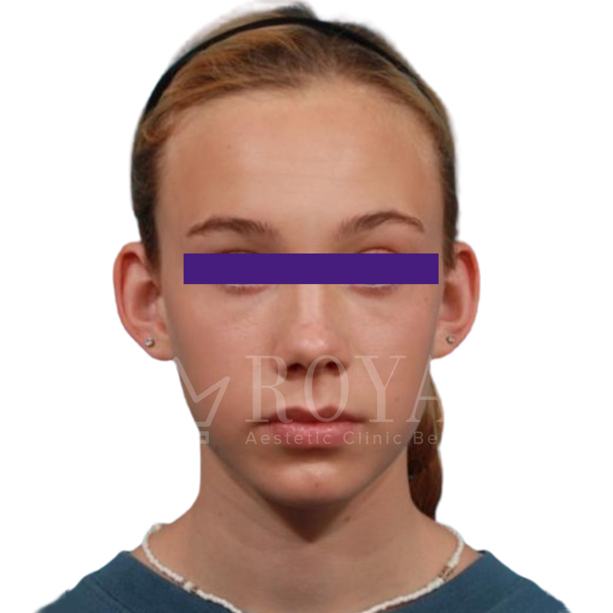 Estetska kirurgija Royal | Pred in po