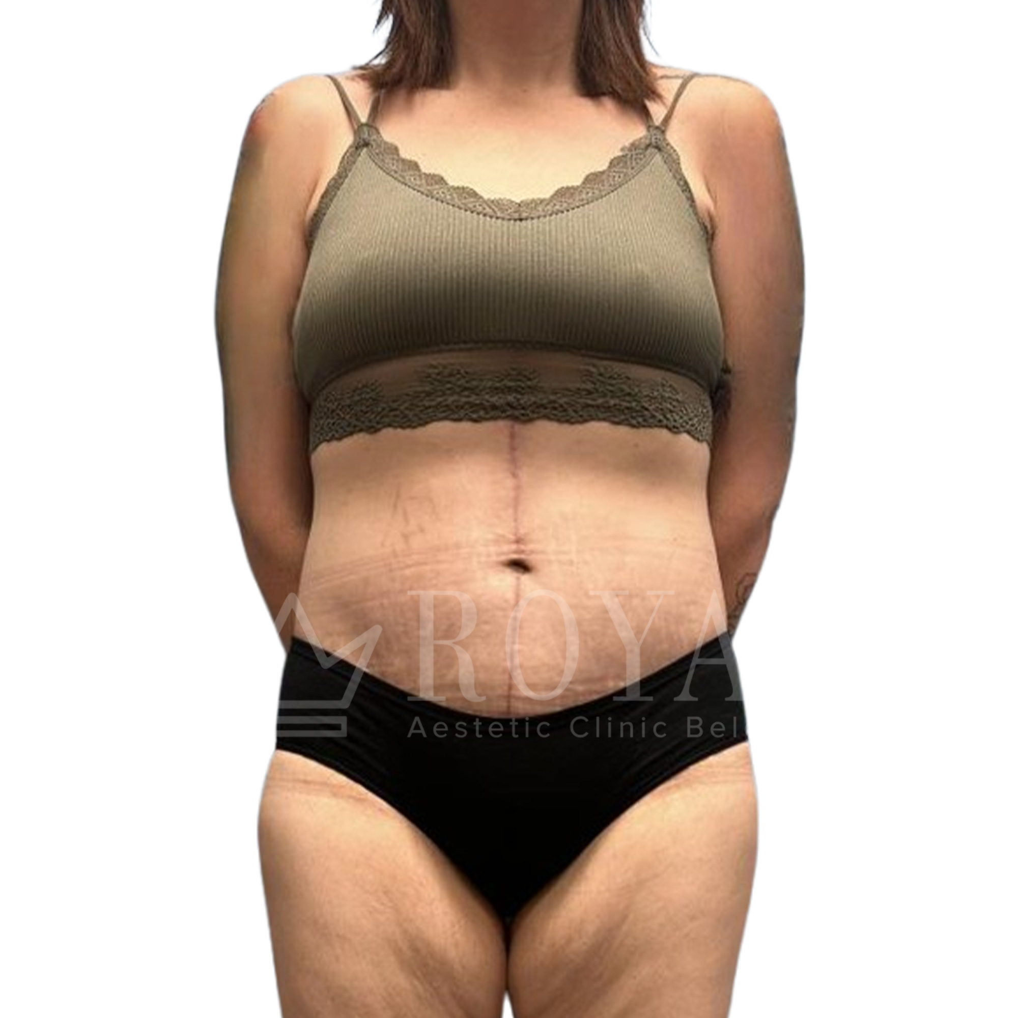 Plastic surgery Royal | Before and after