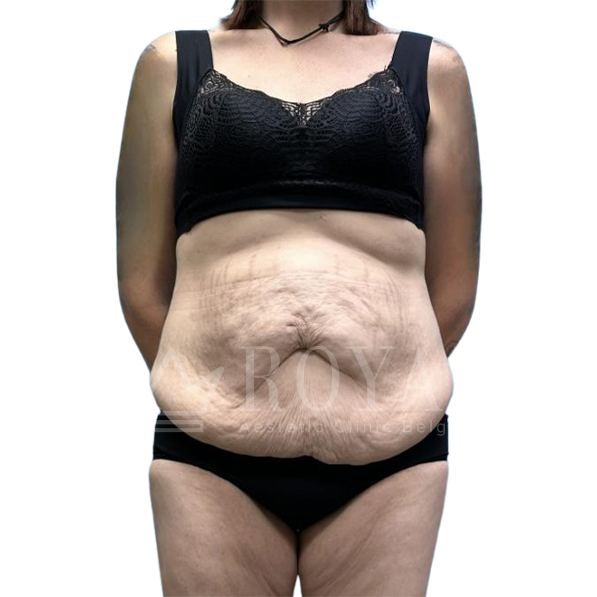 Plastic surgery Royal | Before and after