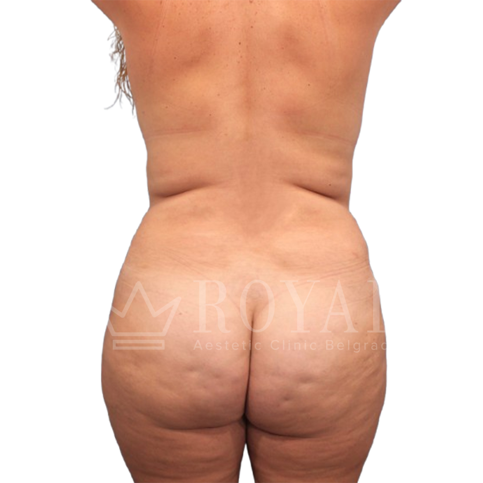 Plastic surgery Royal | Before and after