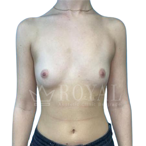 Plastic surgery Royal | Before and after