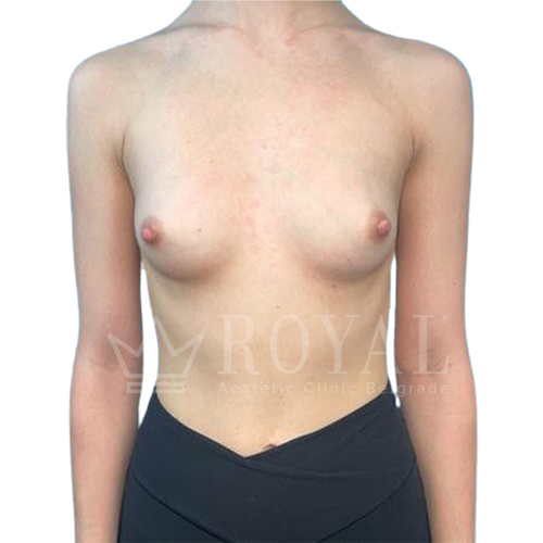 Plastic surgery Royal | Before and after