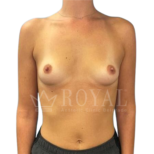 Plastic surgery Royal | Before and after