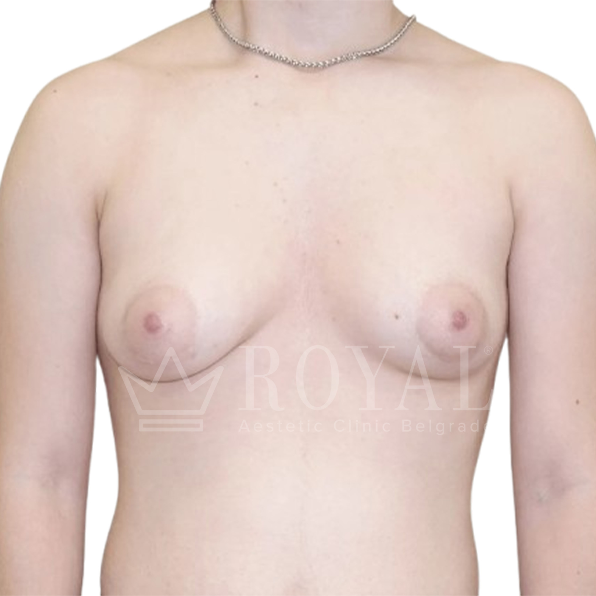 Plastic surgery Royal | Before and after