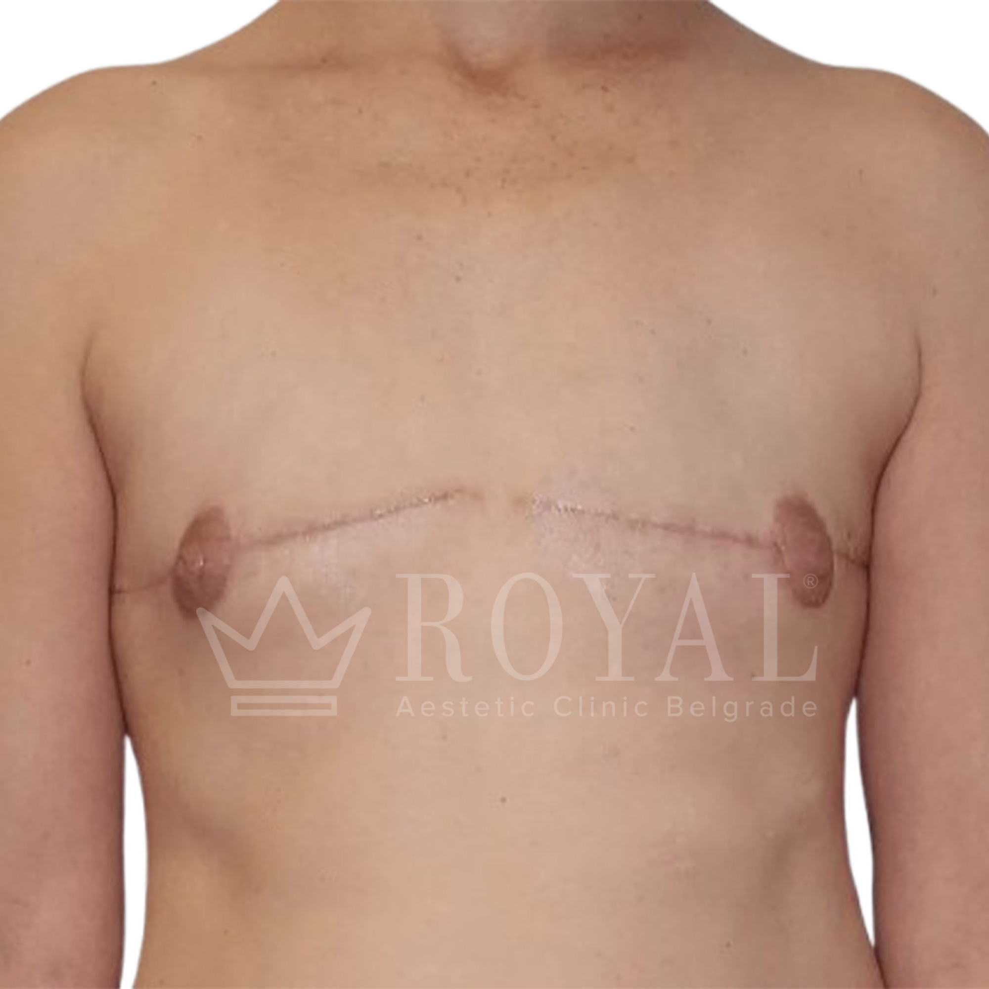 Plastic surgery Royal | Before and after
