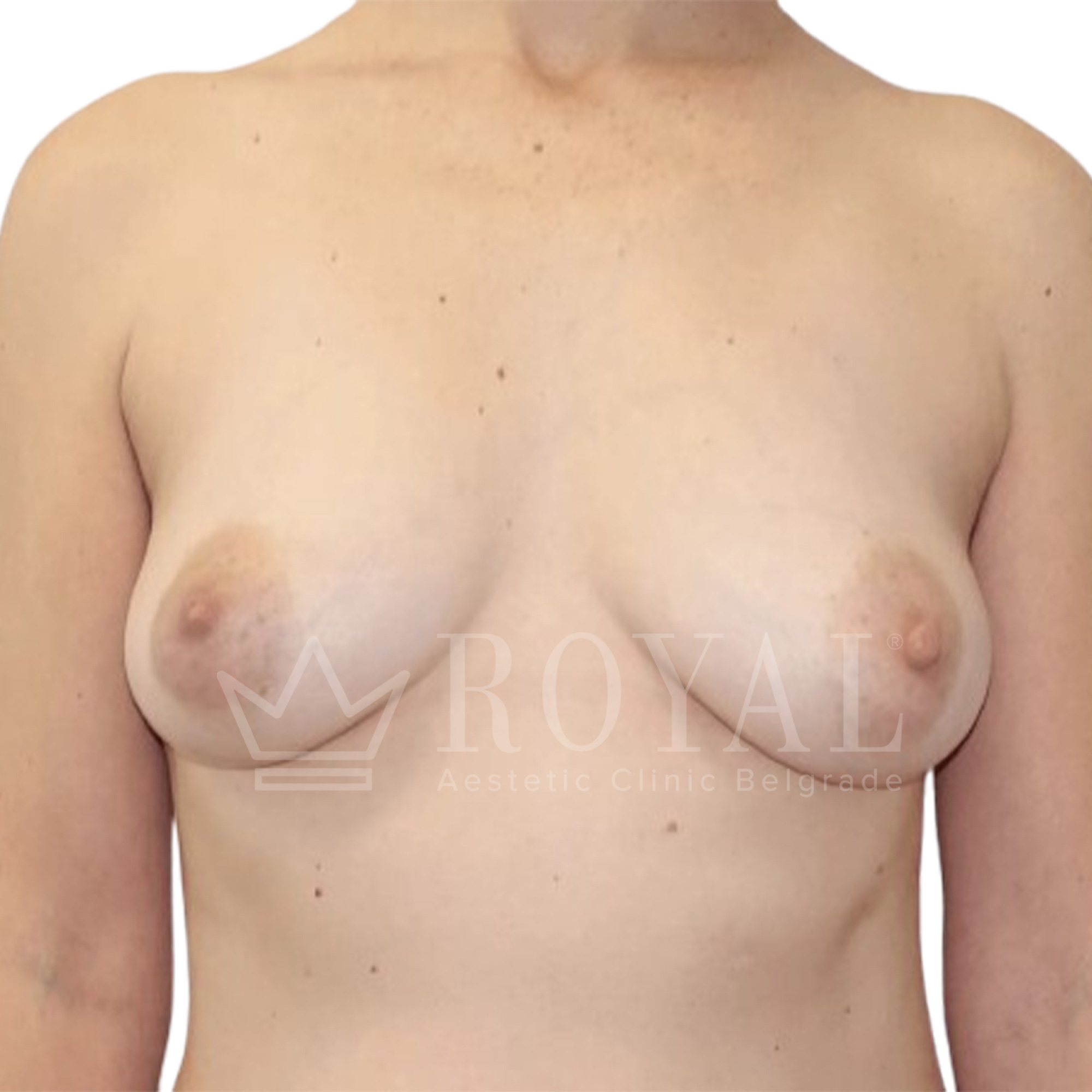Plastic surgery Royal | Before and after