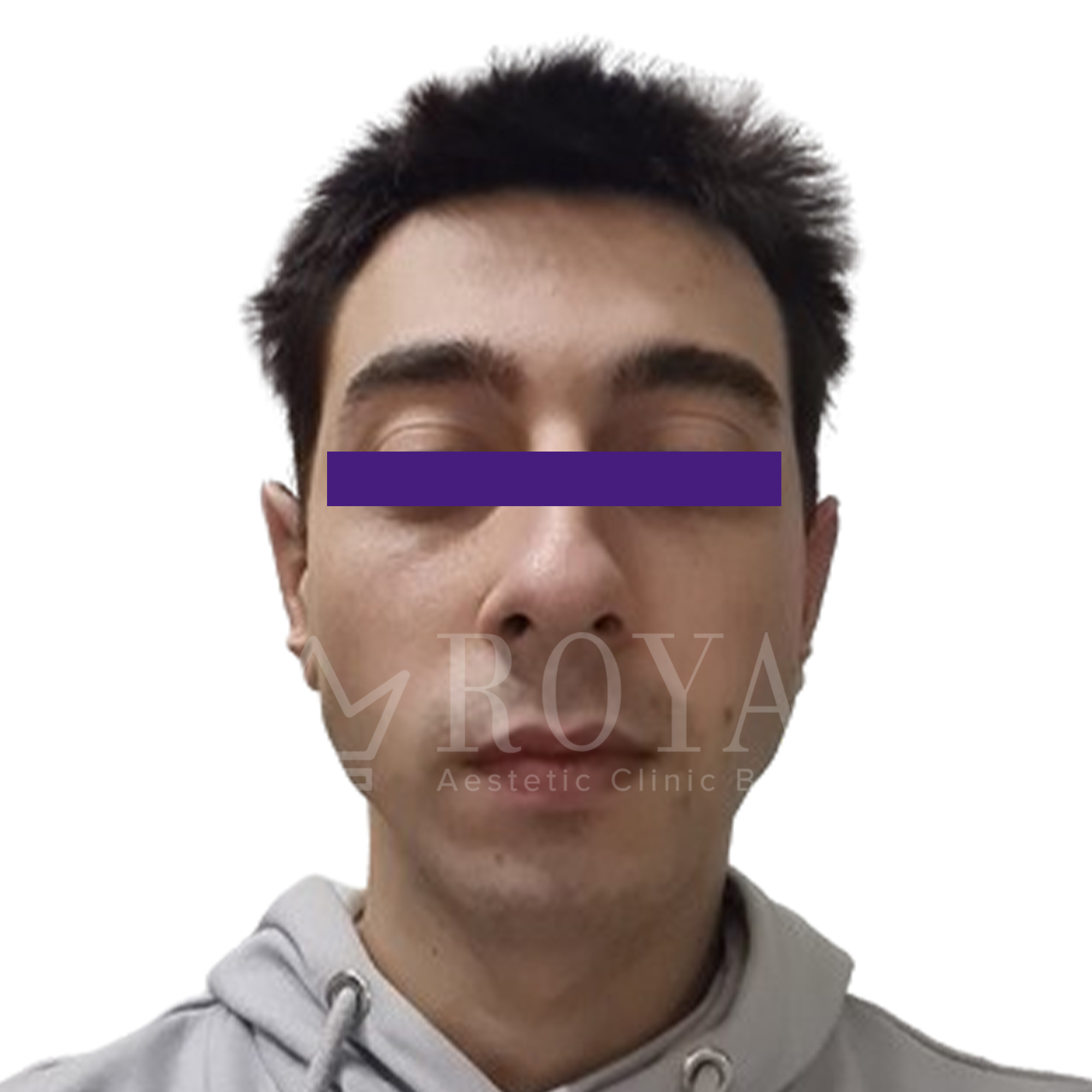 Plastic surgery Royal | Before and after
