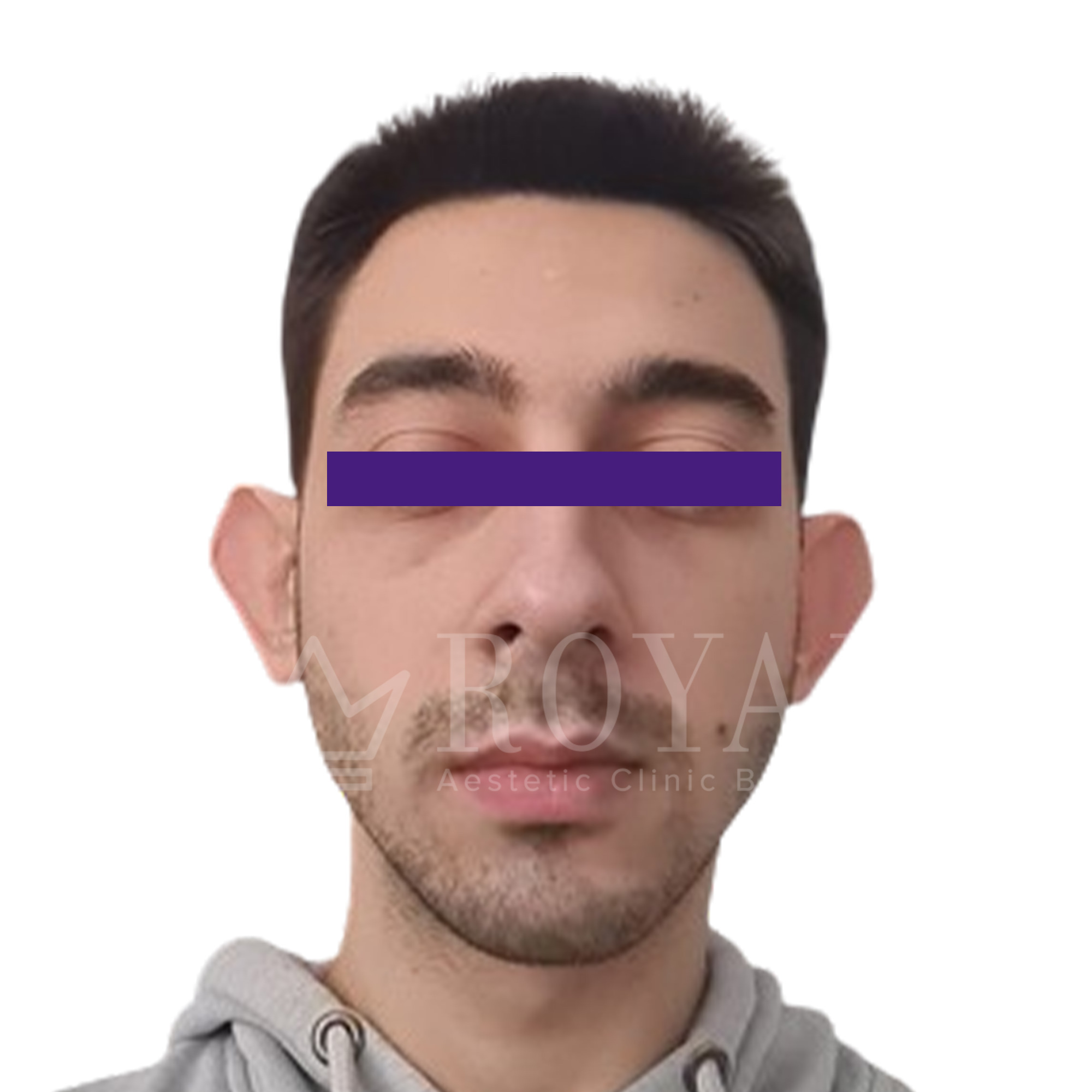 Plastic surgery Royal | Before and after