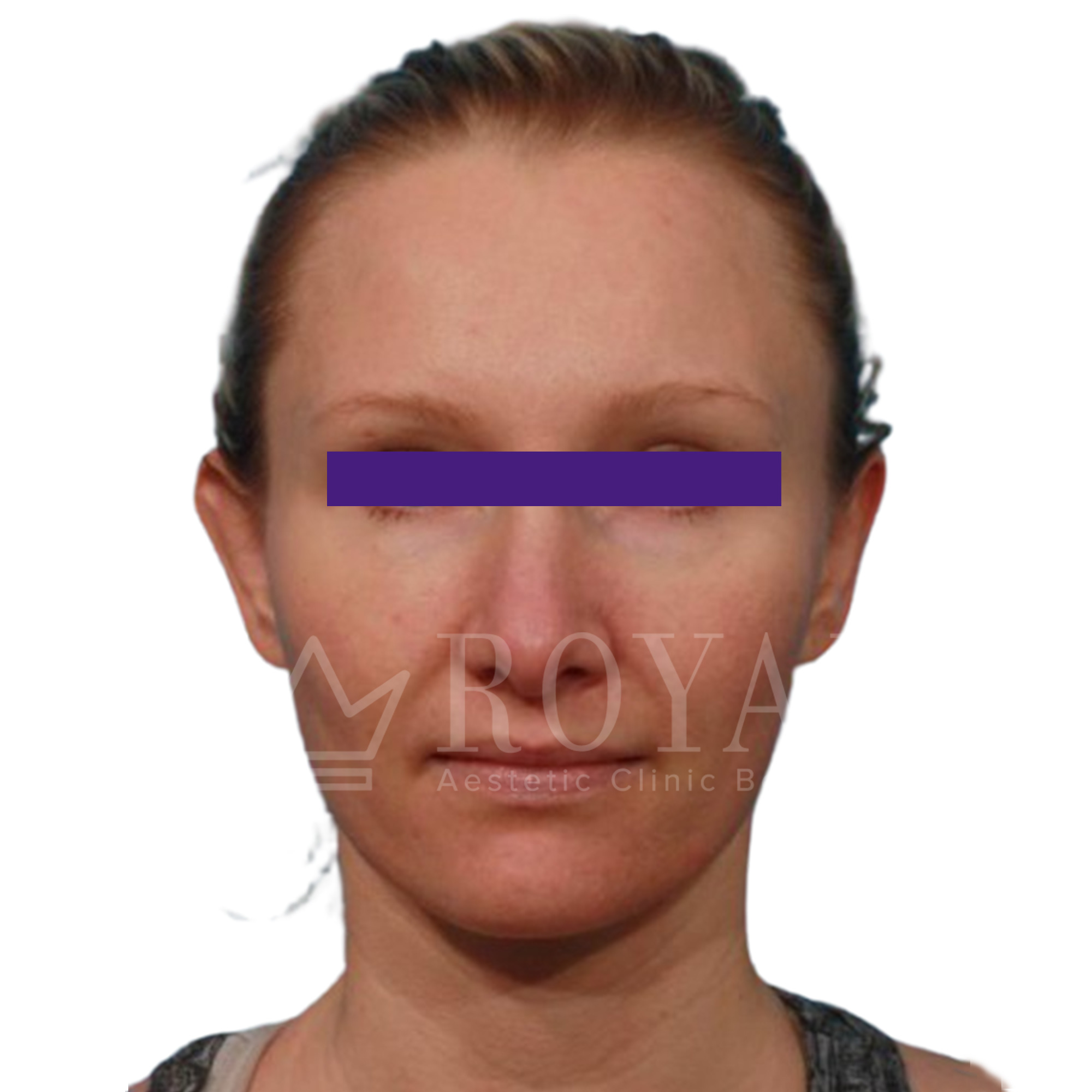 Plastic surgery Royal | Before and after