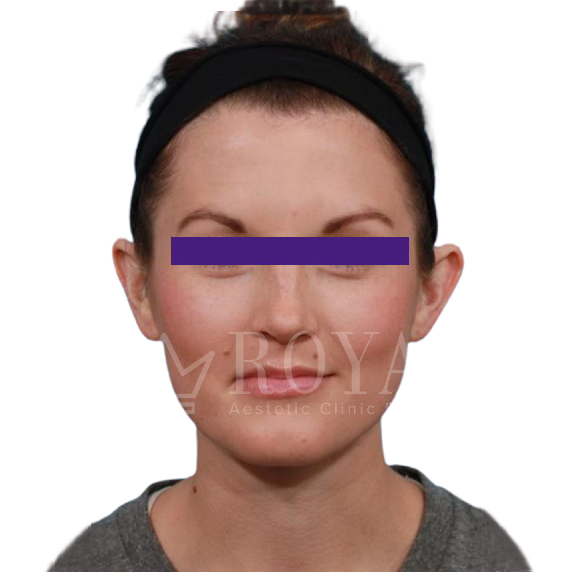 Plastic surgery Royal | Before and after