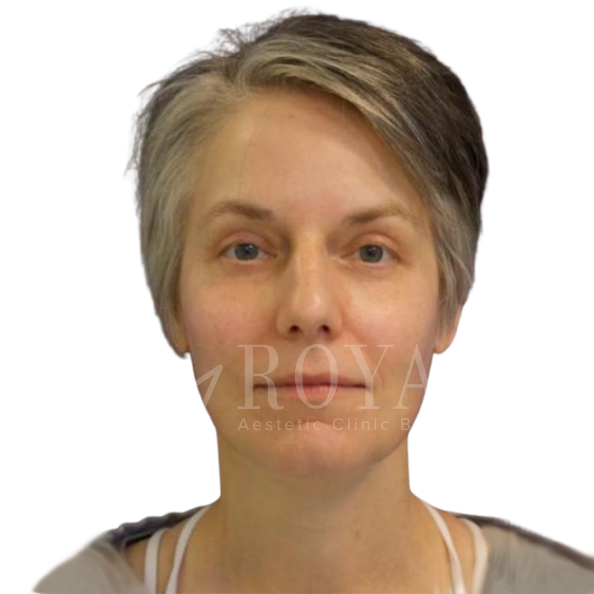 Plastic surgery Royal | Before and after