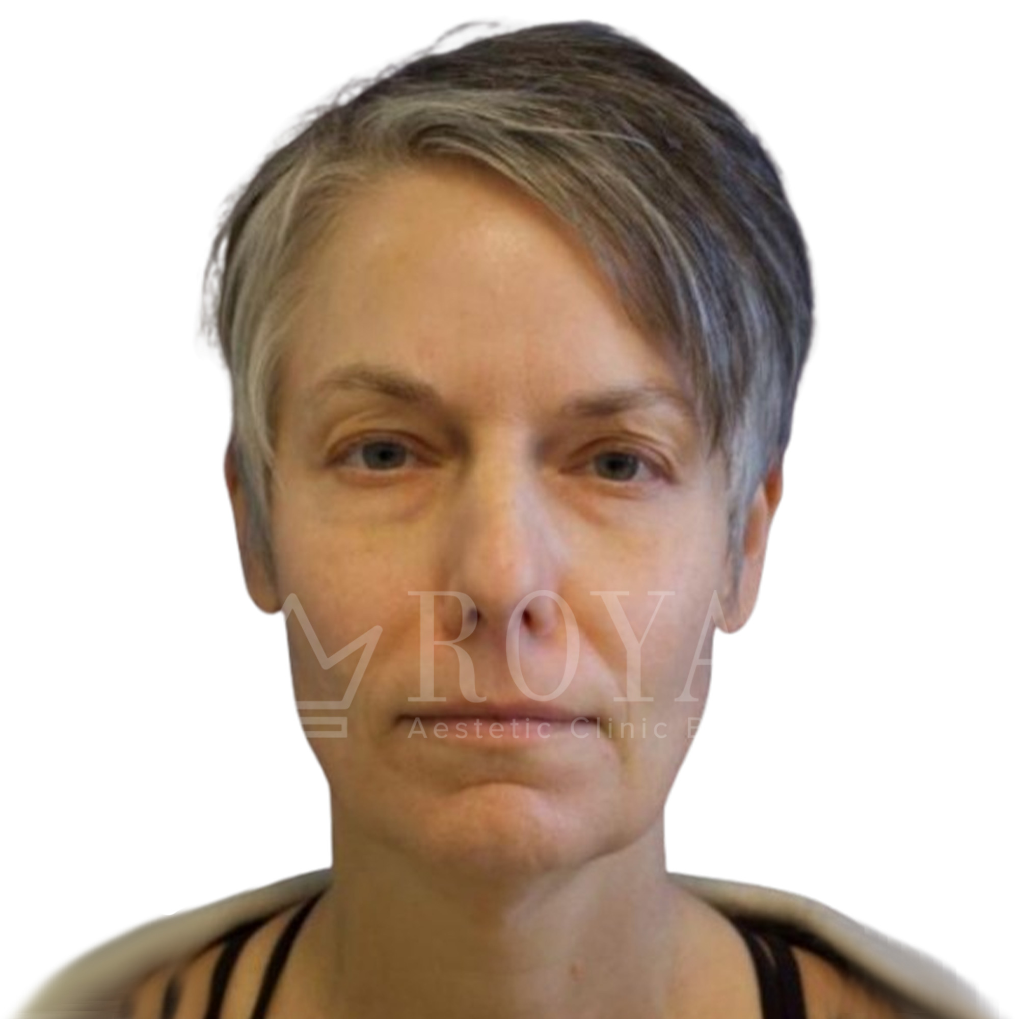 Plastic surgery Royal | Before and after