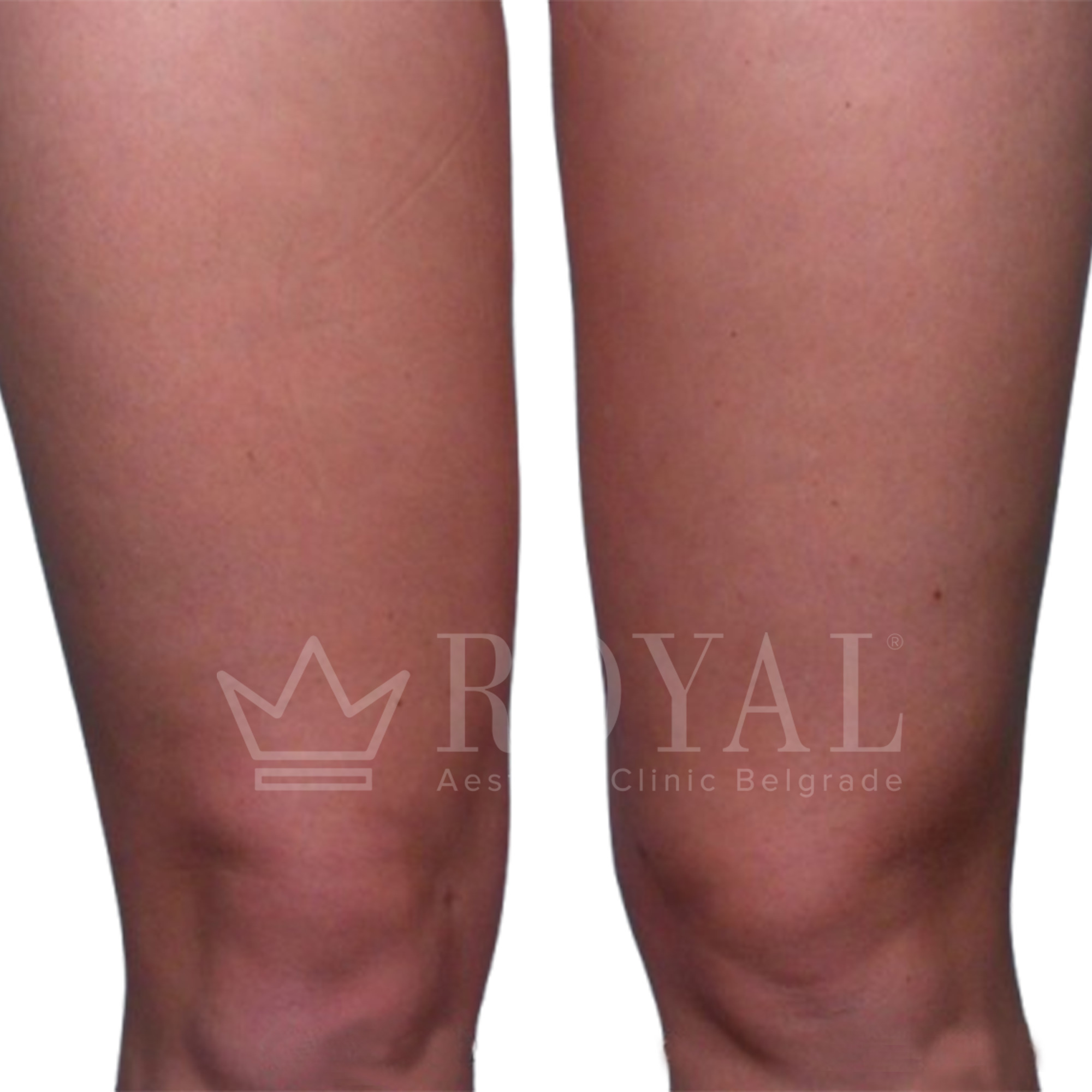 Plastic surgery Royal | Before and after