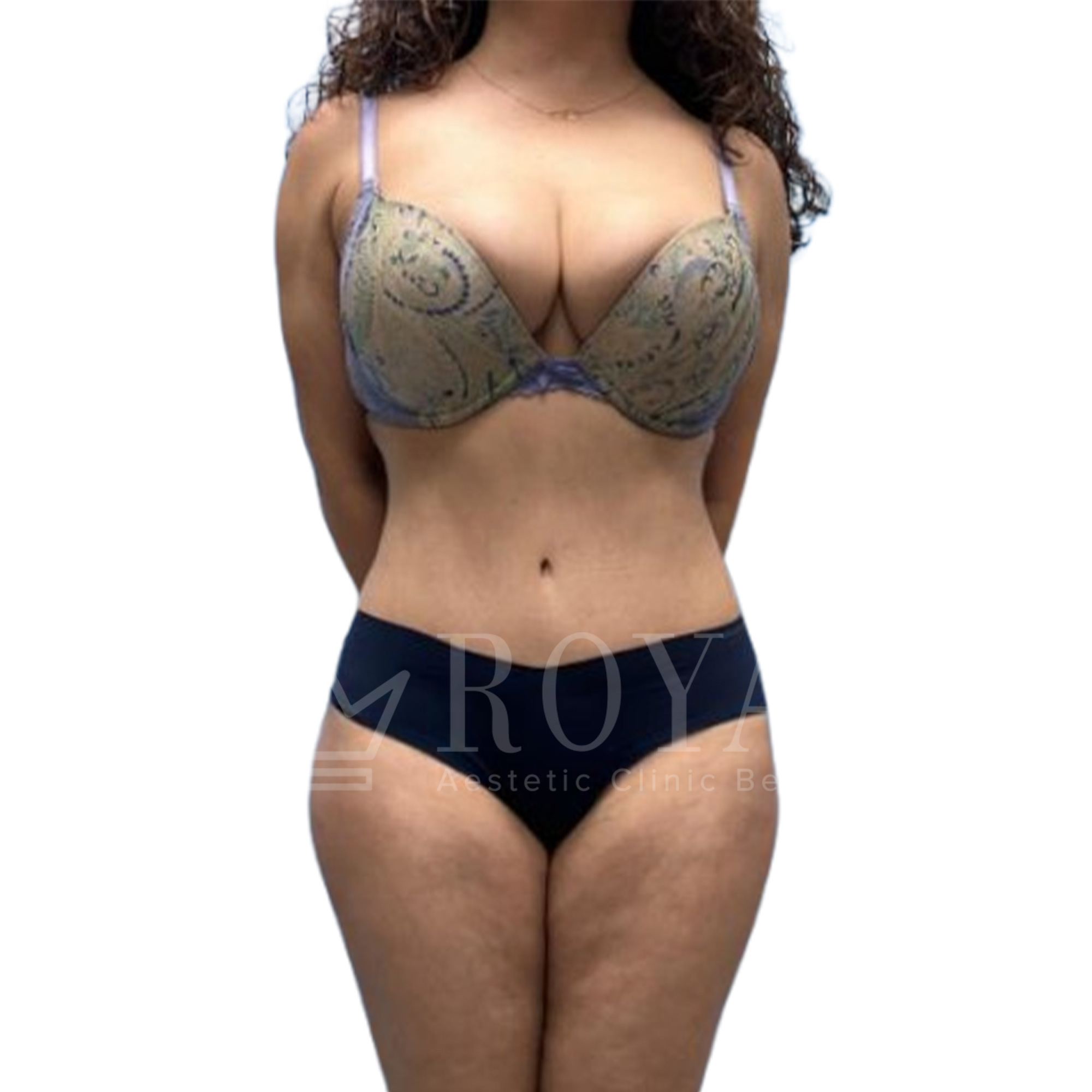 Plastic surgery Royal | Before and after