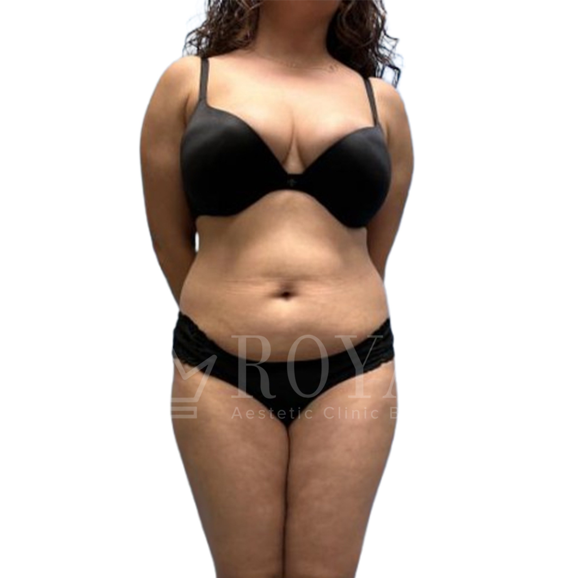 Plastic surgery Royal | Before and after