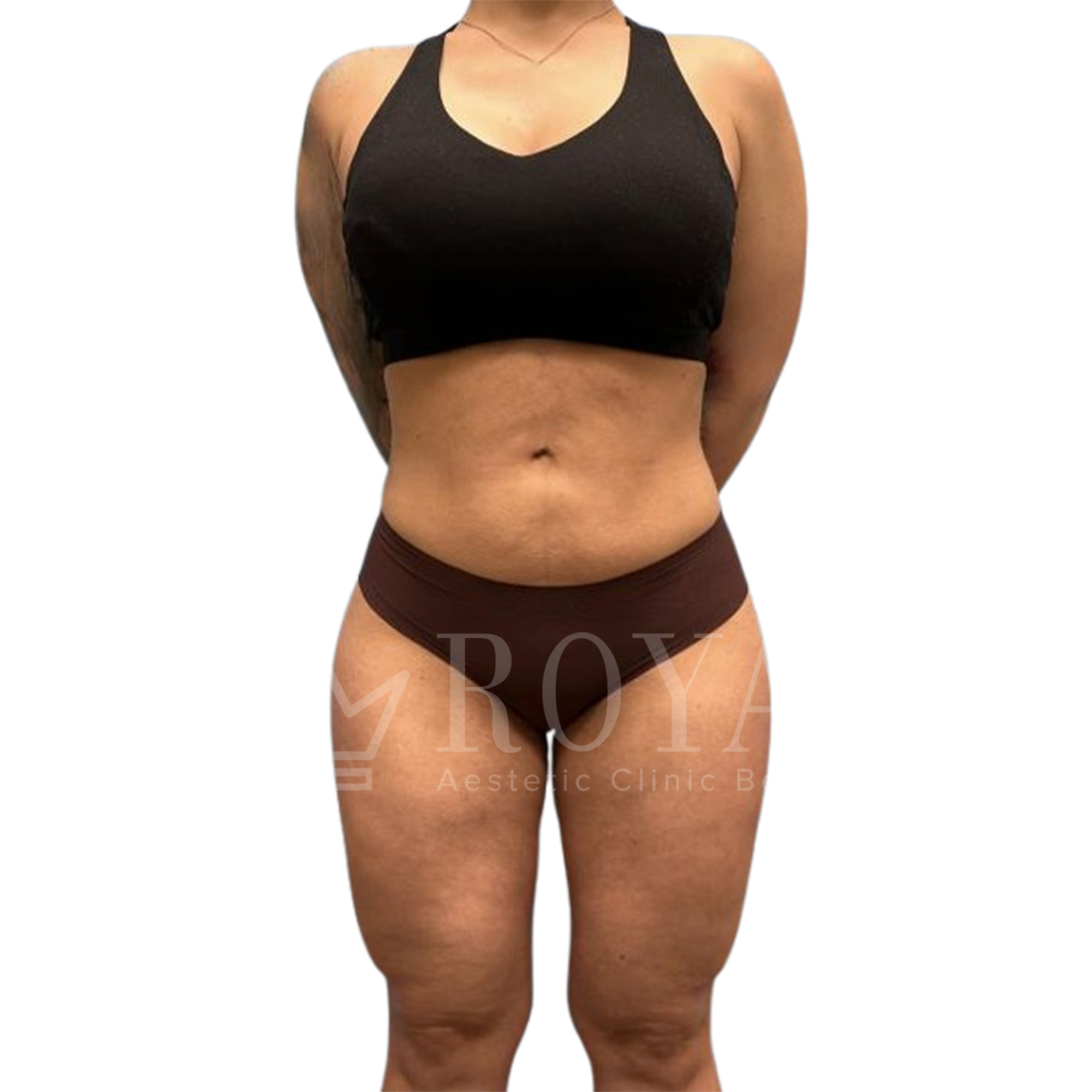 Plastic surgery Royal | Before and after