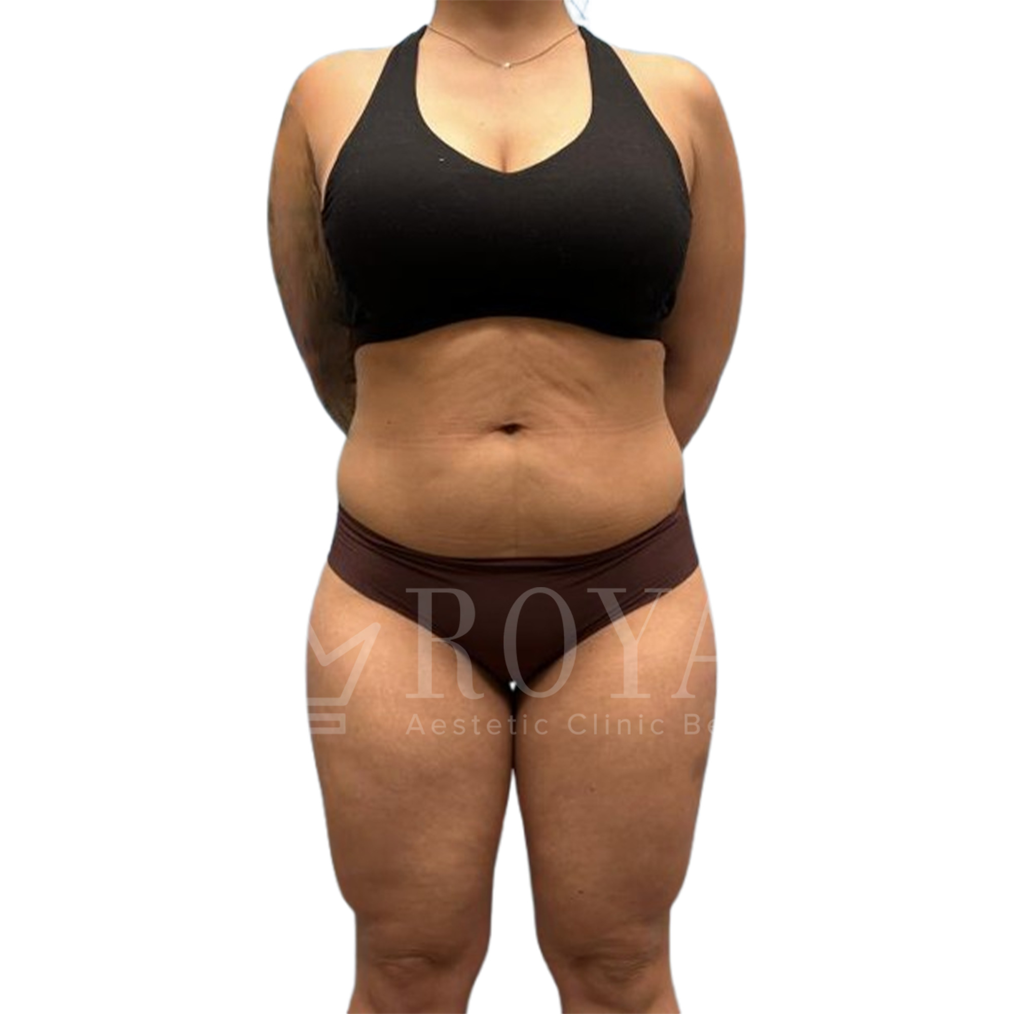 Plastic surgery Royal | Before and after