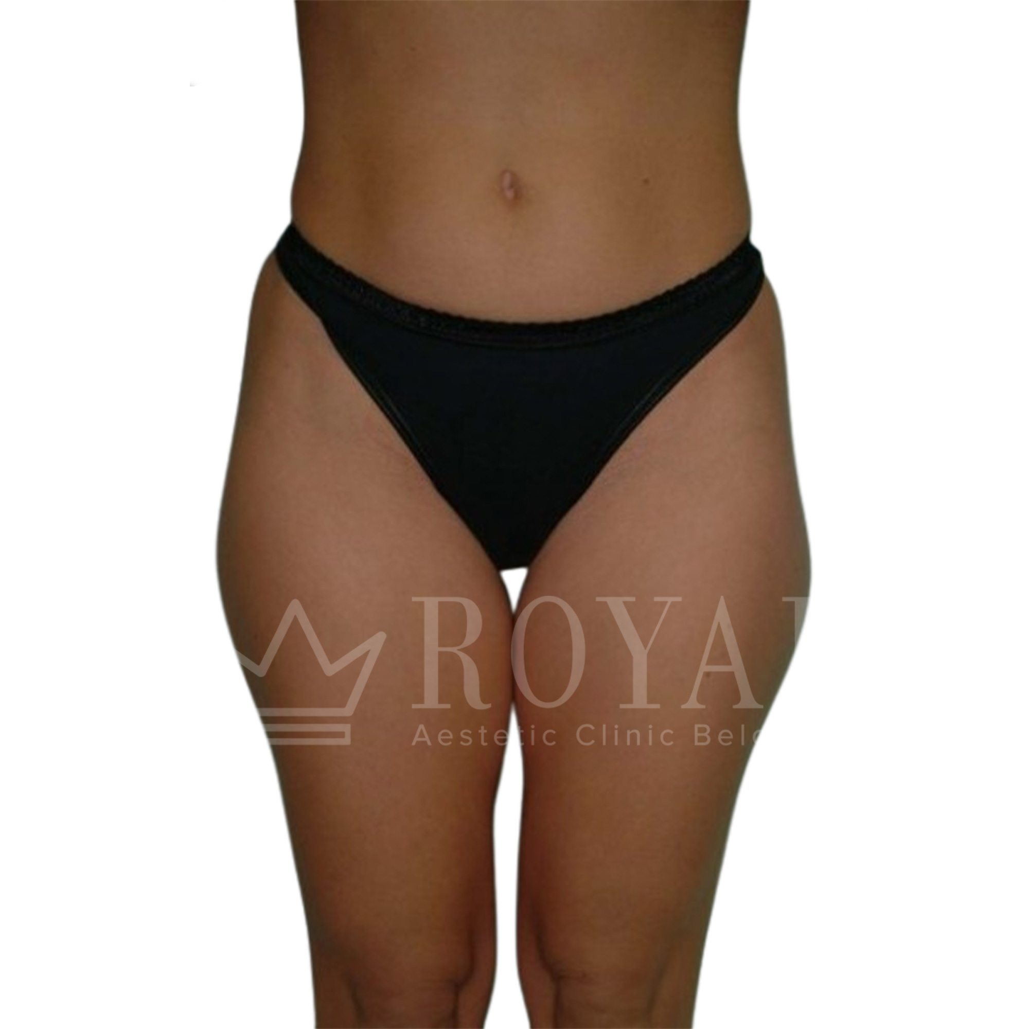 Plastic surgery Royal | Before and after