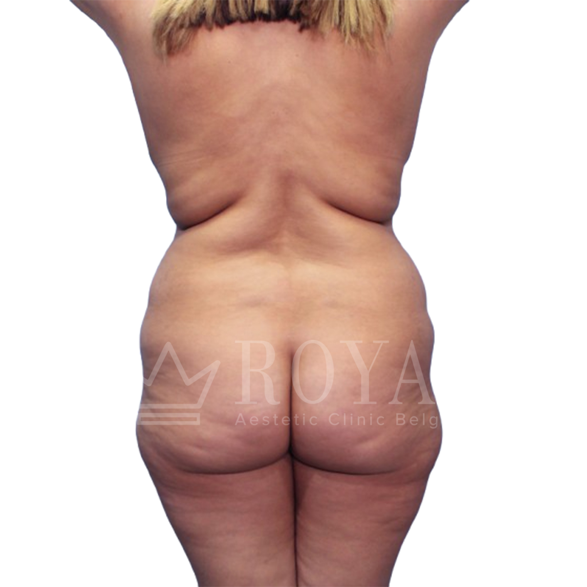 Plastic surgery Royal | Before and after