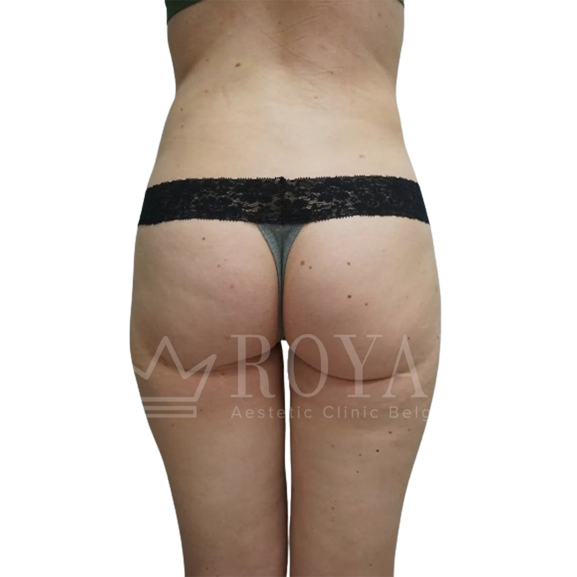 Plastic surgery Royal | Before and after