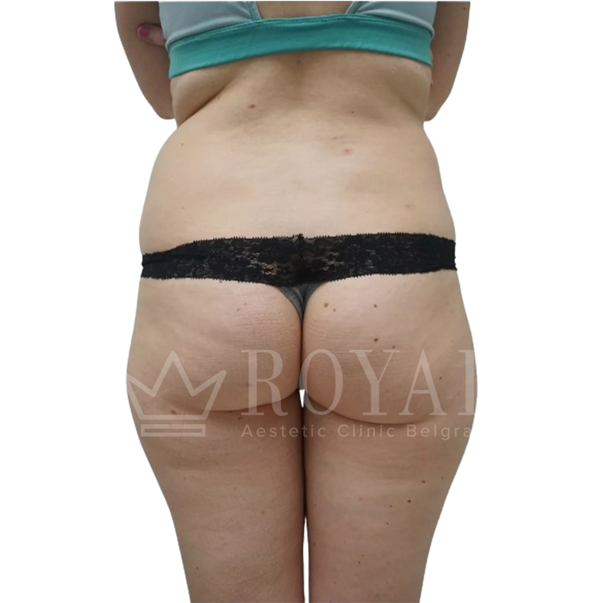 Plastic surgery Royal | Before and after