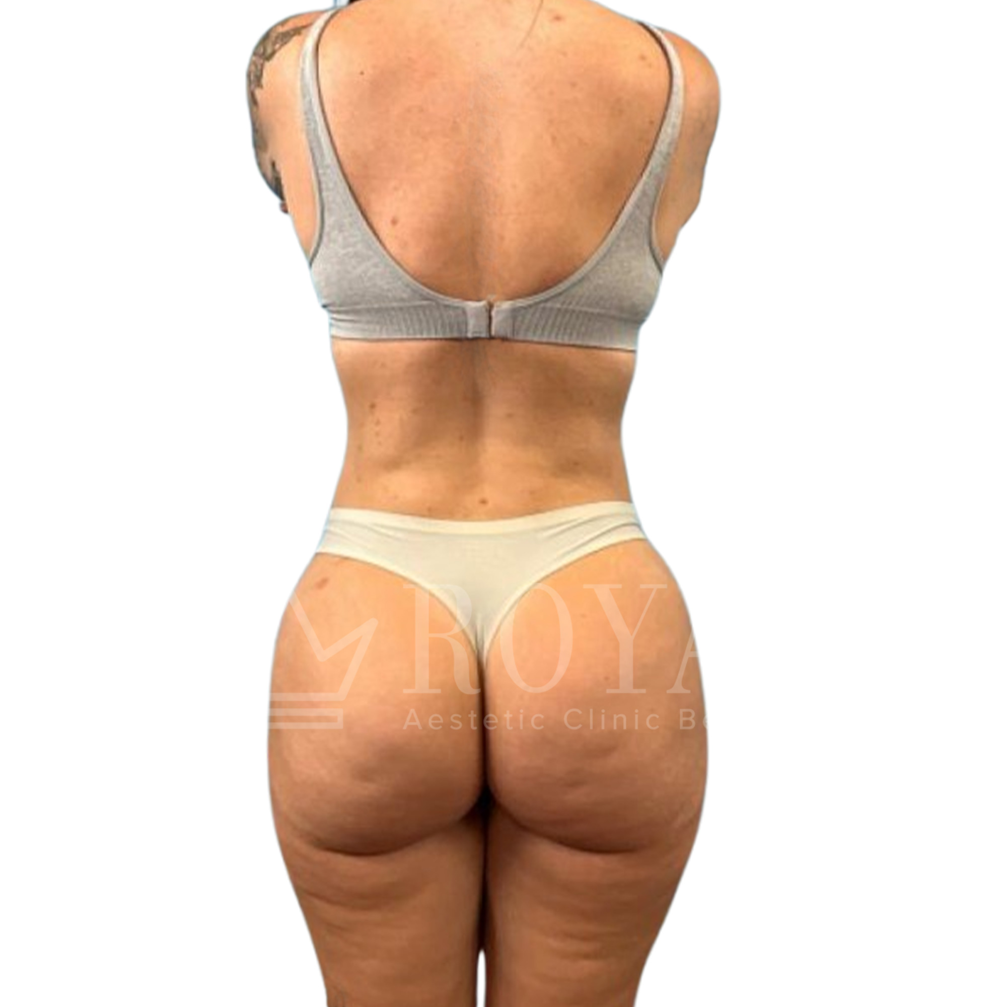 Plastic surgery Royal | Before and after