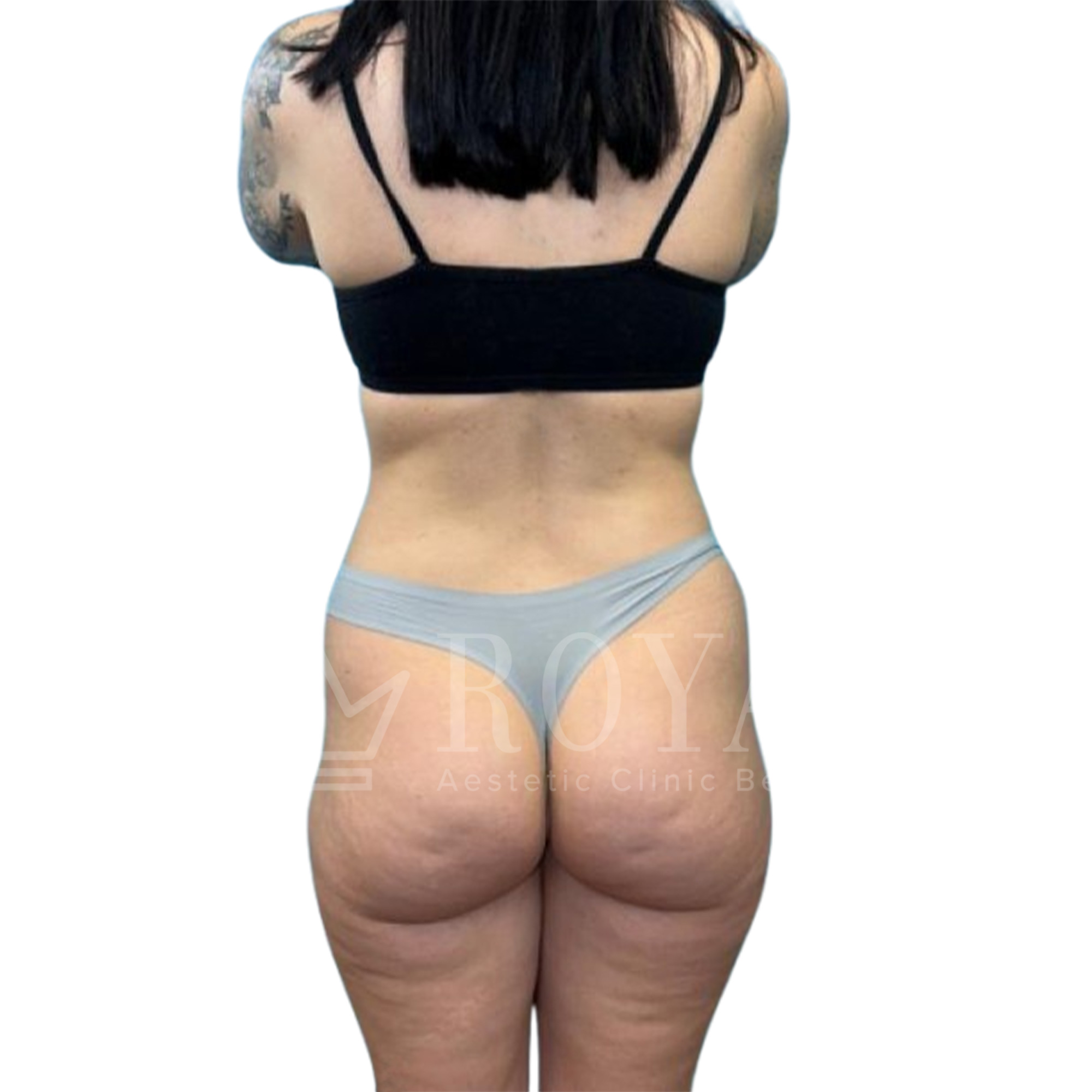 Plastic surgery Royal | Before and after