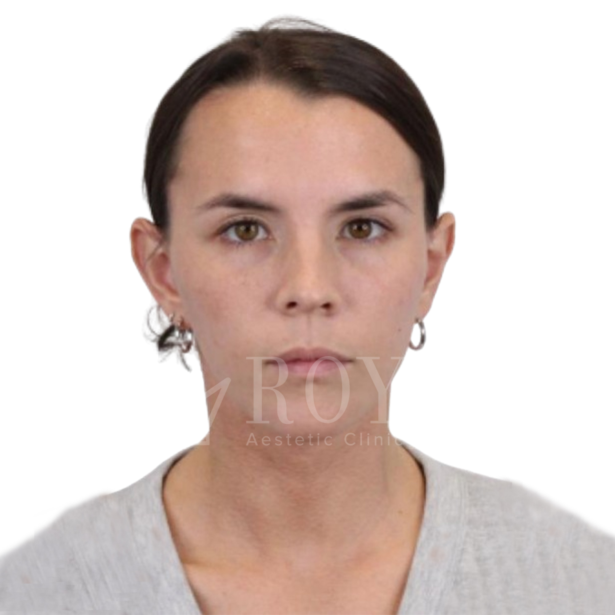 Plastic surgery Royal | Before and after