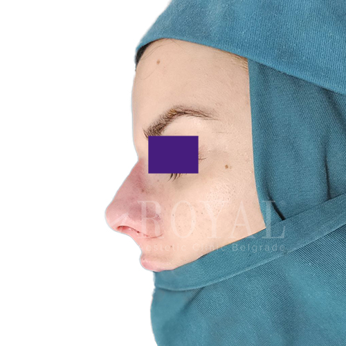 Plastic surgery Royal | Before and after