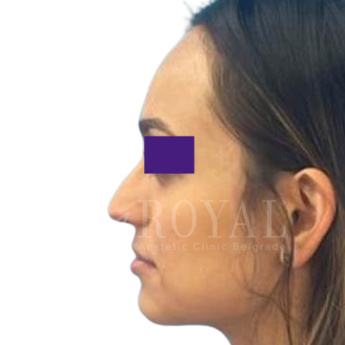 Plastic surgery Royal | Before and after