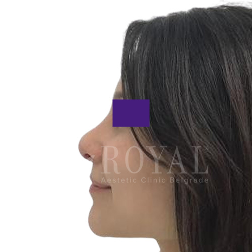 Plastic surgery Royal | Before and after