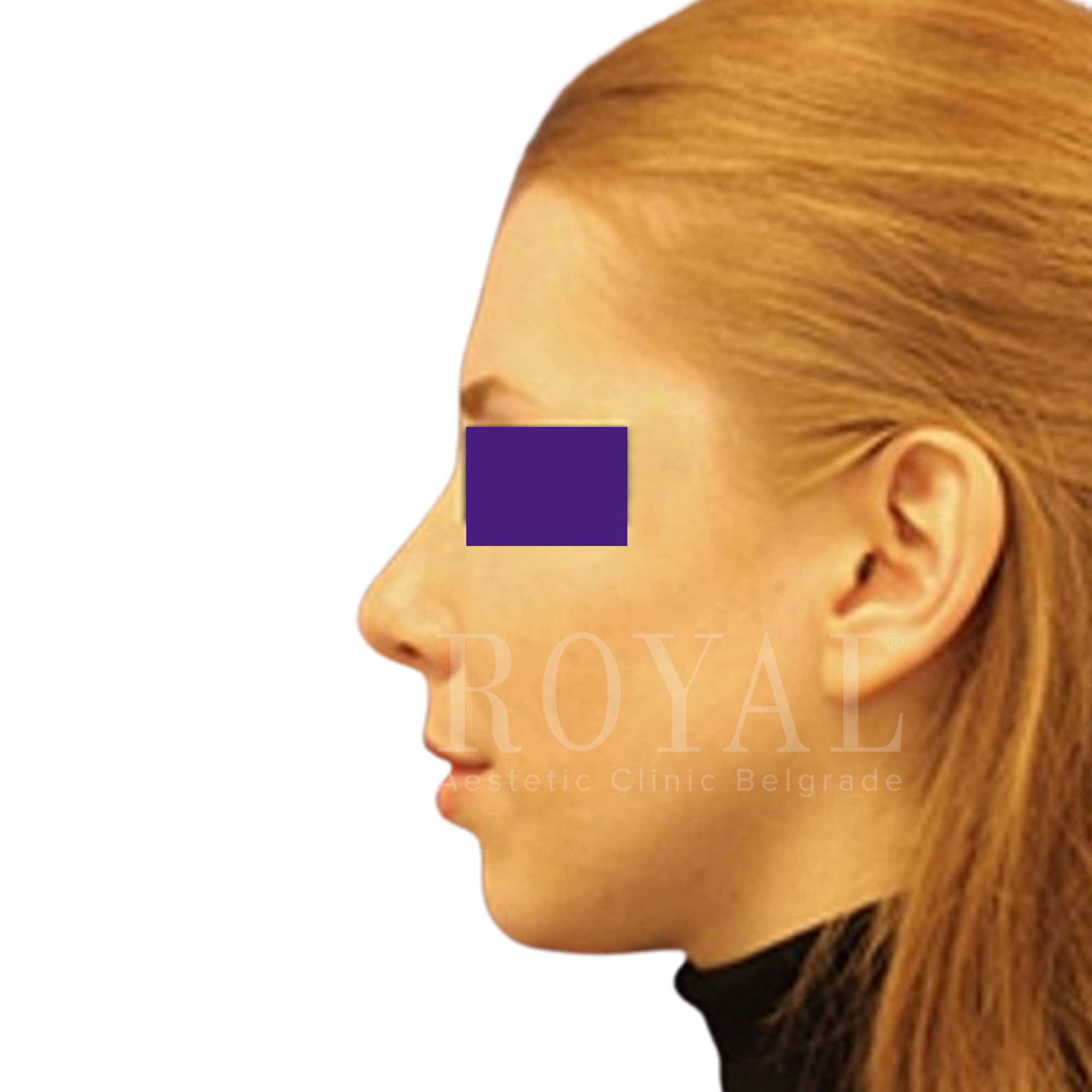 Plastic surgery Royal | Before and after