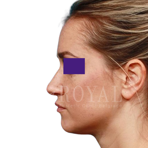 Plastic surgery Royal | Before and after