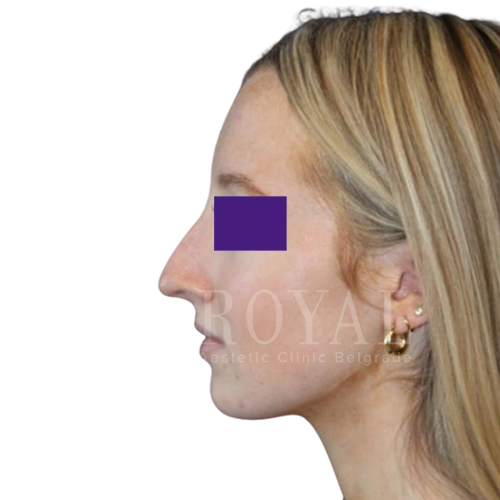Plastic surgery Royal | Before and after