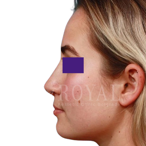 Plastic surgery Royal | Before and after